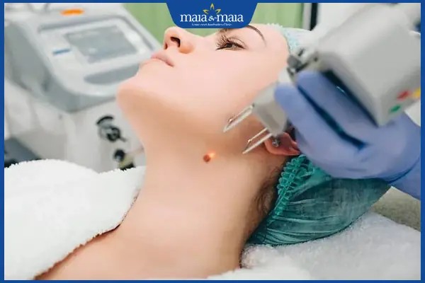Công nghệ laser hiện đại giúp tẩy nốt ruồi an toàn và hiệu quả.