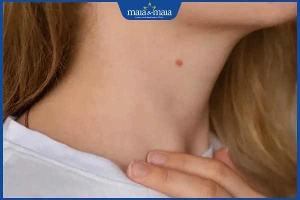 Nốt ruồi ở vị trí cằm gần cổ thường liên quan đến trách nhiệm và sự chu đáo.